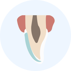 일반 라미네이트